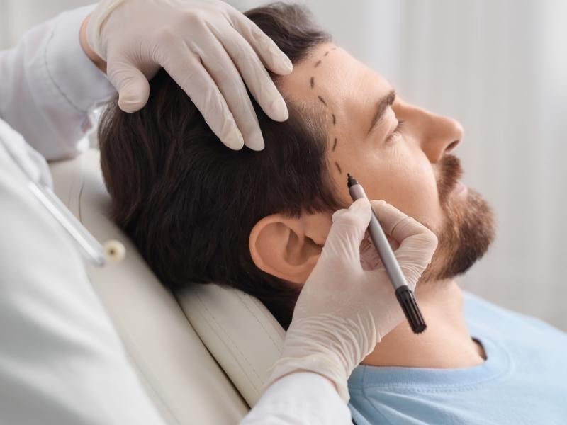 Responsabilidade civil do médico em casos de transplante capilar